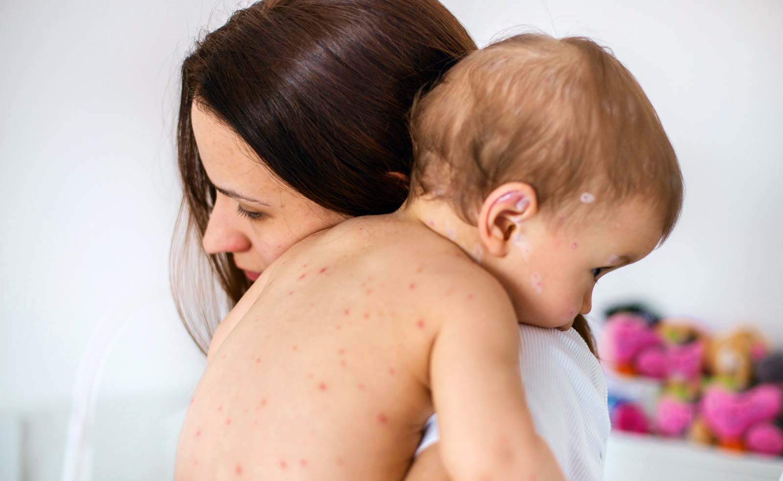 La OMS y Unicef alertan que los casos de sarampión han subido un 79%