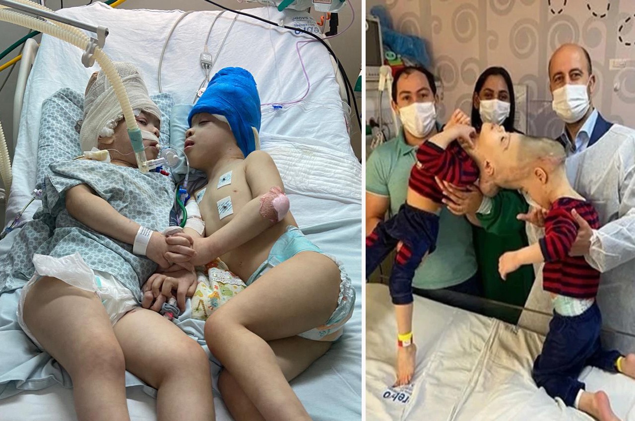 Siameses unidos por la cabeza son separados exitosamente