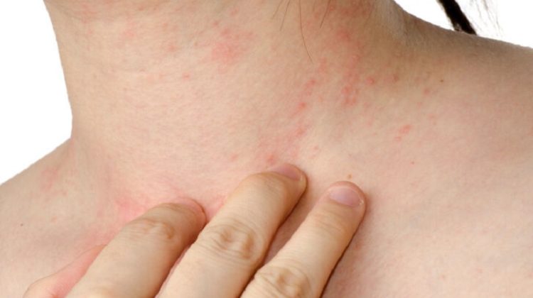 La FDA aprueba el primer medicamento para reducir las reacciones alérgicas por alimentos
