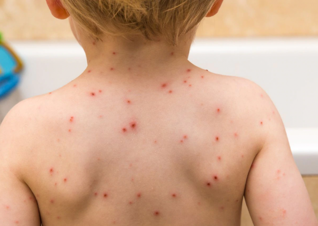 Los CDC alertan sobre el aumento de casos de sarampión en Estados Unidos