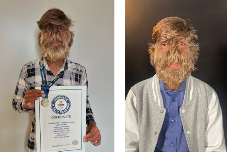 Un adolescente en la India con ‘síndrome del hombre lobo’ rompe récord Guinness por el rostro más peludo Un adolescente en la India con ‘síndrome del hombre lobo’ rompe récord Guinness por el rostro más peludo
