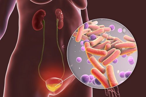 La FDA aprobó un nuevo antibiótico para las infecciones urinarias en mujeres y niñas mayores de 12 años